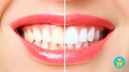 Trước và sau khi tẩy trắng răng tại Phòng khám Nha Khoa Sài Gòn