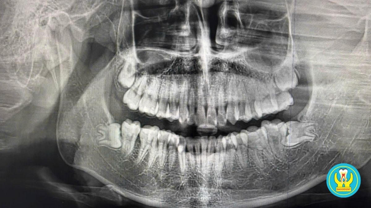 Ảnh chụp biến chứng răng khôn tại Phòng khám Nha Khoa Sài Gòn