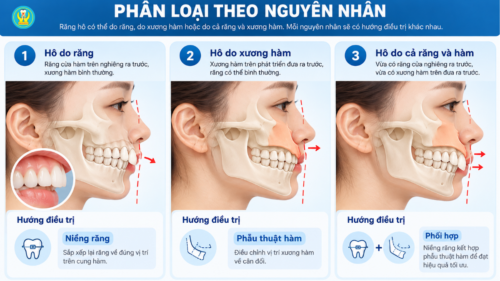 Ba dạng răng hô, hô do răng, hô do hàm và hô hỗn hợp