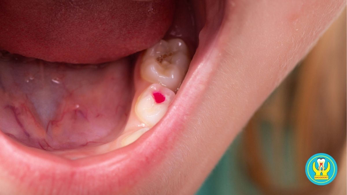 Điều trị viêm tủy răng bằng phương pháp nội nha tại phòng khám nha khoa