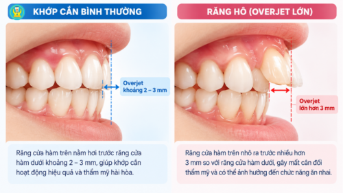 Độ cắn chìa răng hô so với khớp cắn bình thường 2 đến 3 mm