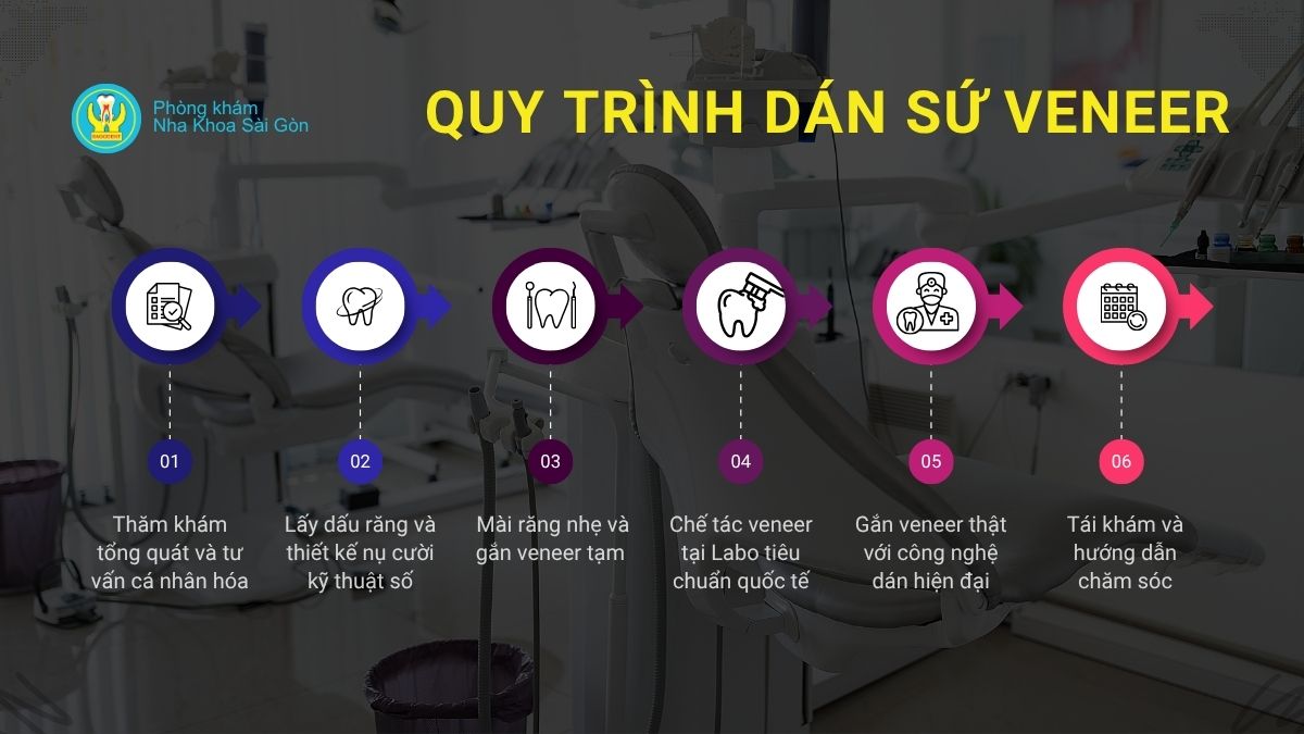 Quy trình dán sứ veneer chuẩn 6 bước tại Nha khoa Sài Gòn
