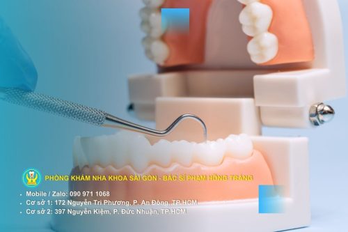 Bựa răng gây ra các sức khoẻ về răng miệng