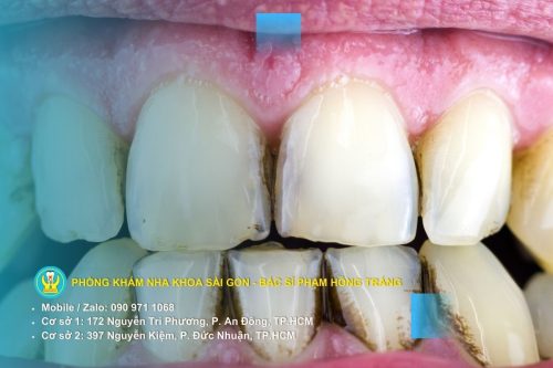 Bựa răng là gì và cách khắc phục