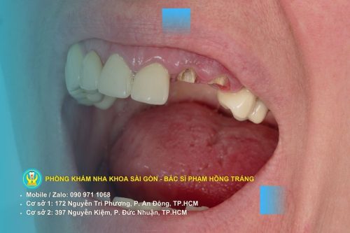 Phòng ngừa răng hư tổn: chăm sóc và vệ sinh răng miệng đúng cách
