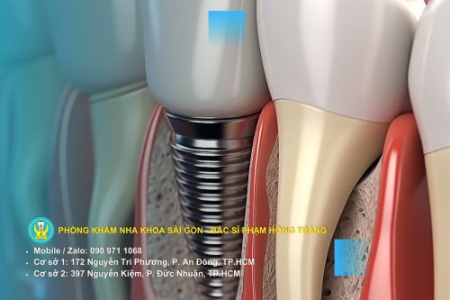 Rủi ro cấy ghép implant bệnh nhân được tư vấn chăm sóc hậu phẫu và tái khám định kỳ