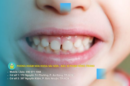 Các nguyên nhân hình thành răng thừa ở người lớn và trẻ em