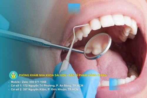 Điều trị ngà văng bằng cách xác định cấp độ và những vấn đề liên quan