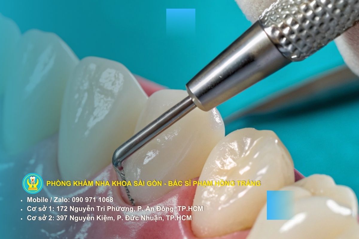 Trám răng tạm thời có đau không và mất bao lâu có thể hoàn thiện