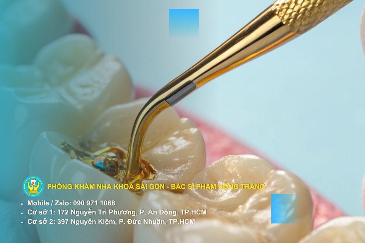 Trám răng tạm thời và công dụng đối với bệnh nhân
