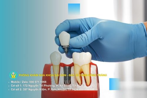 Trồng răng bằng hàm giả tháo lắp và giải pháp tiết kiệm cho người mất nhiều răng