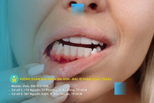 Xử lý ngay vấn đề chảy máu chân răng để tránh bệnh lý nha chu