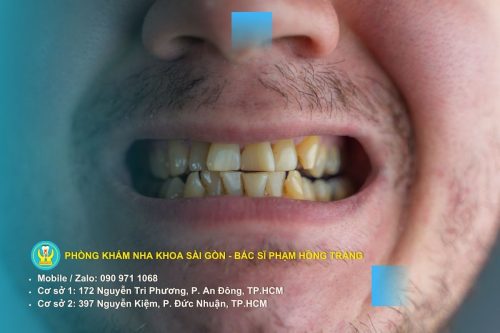 Ảnh minh họa hàm răng bị ố vàng, cao răng và hôi miệng nghiêm trọng do tác hại của thuốc lá