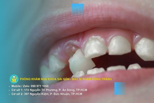 Các yếu tố nguy cơ làm tăng tình trạng mất răng