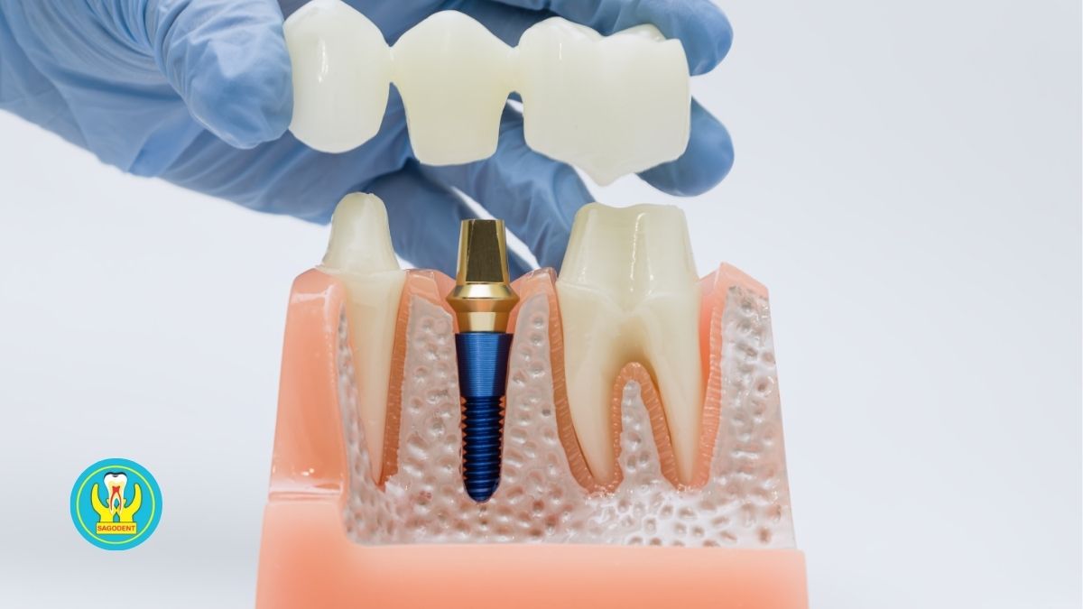 Các yếu tố quyết định đến độ bền của răng sứ vĩnh viễn
