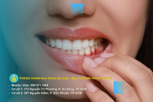 Chảy máu chân răng do viêm nướu và mảng bám tích tụ quanh răng