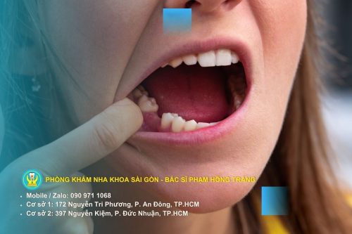 Mất răng và nguyên nhân