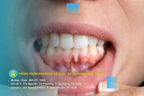 Nguyên nhân gây chảy máu chân răng do vệ sinh răng miệng không đúng cách