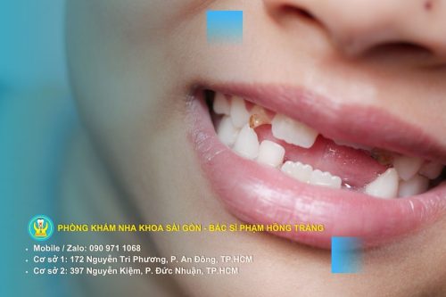 Nguyên nhân gây mất răng