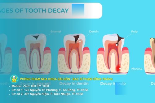 Phân tích nguyên nhân sâu răng theo khoa học