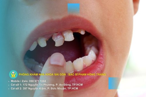 Phương pháp điều trị sâu răng