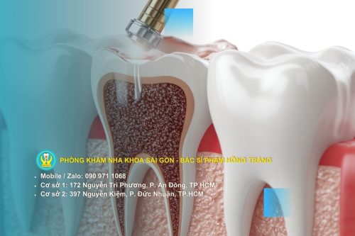 Dấu hiệu nhận biết răng đã bị chết tủy qua từng giai đoạn
