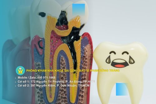 Dấu hiệu nhận biết răng sâu độ 1 điển hình