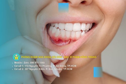 Dấu hiệu tụt nướu tại người lớn và trẻ em