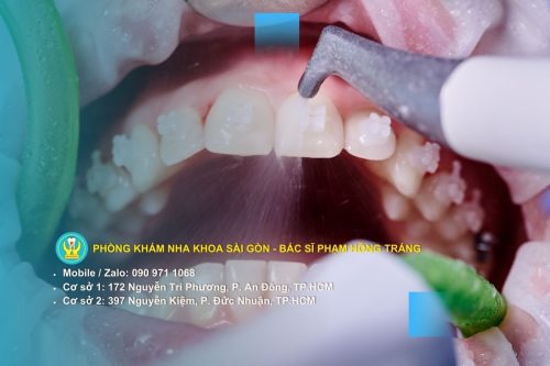 Giải Pháp Khắc Phục và Điều Trị Chuyên Sâu răng bị xỉn đen