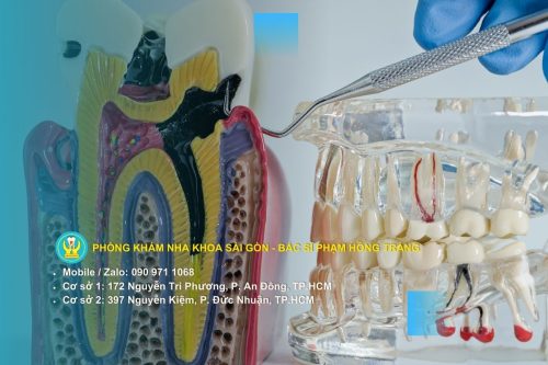 Nguyên nhân phổ biến dẫn đến chết tủy răng
