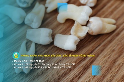 Tại sao phải phục hồi răng cửa sớm
