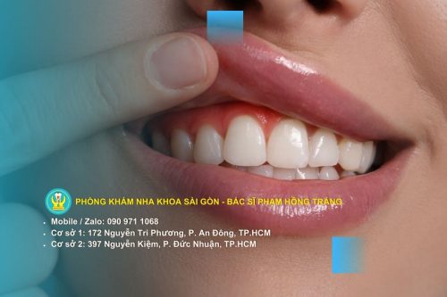 Tụt nướu khi không cạo vôi răng
