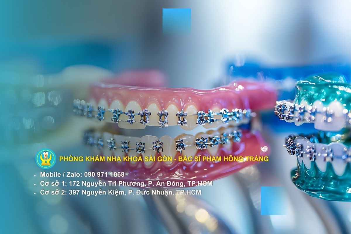Chuẩn bị toàn diện trước khi bắt đầu hành trình niềng răng