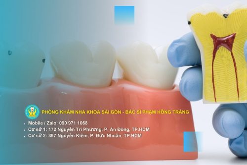 Dấu hiệu nhận biết viêm tủy răng không thể bỏ qua