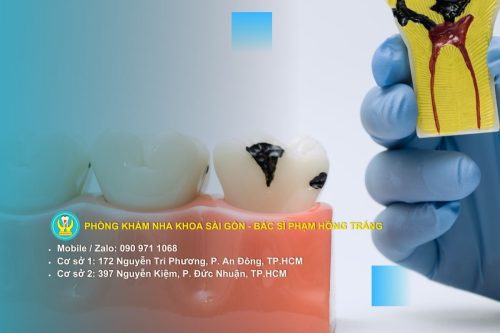 Quy trình điều trị tủy chuẩn y khoa tại phòng khám