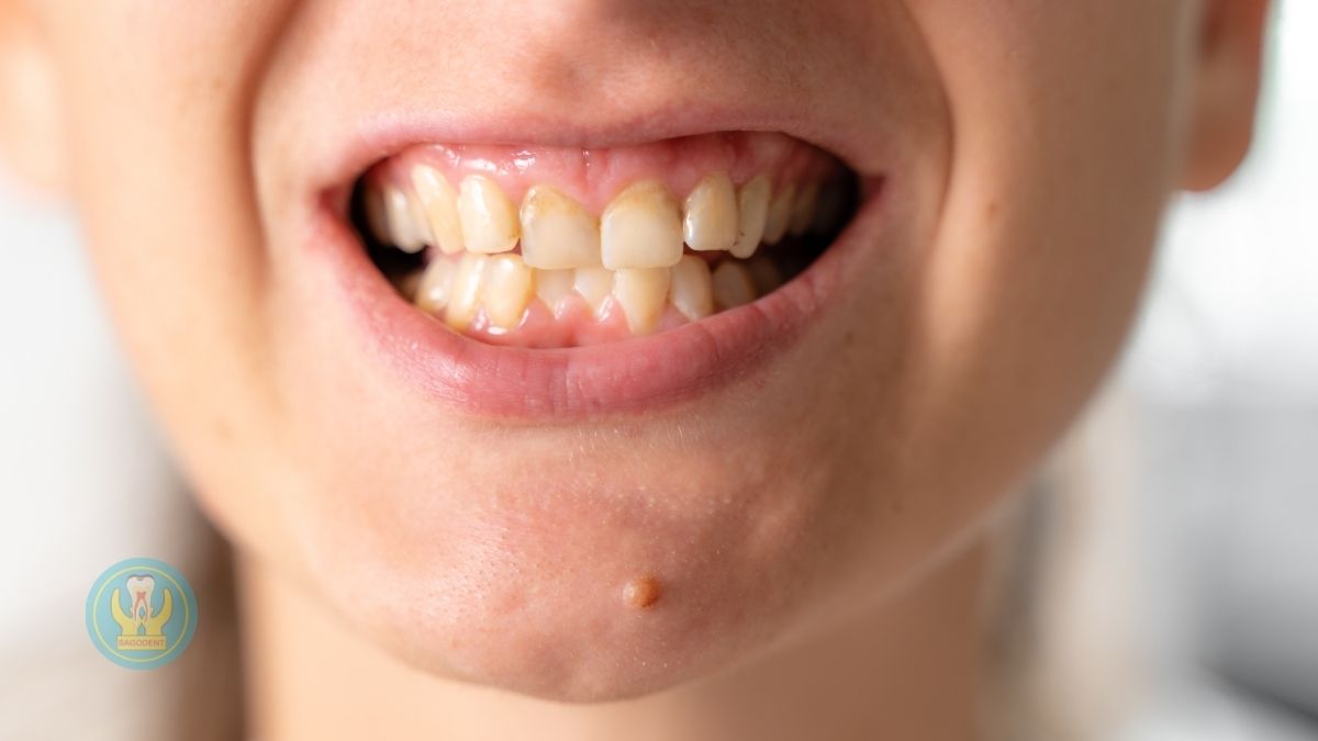 Các dạng sai lệch khớp cắn phổ biến giải đáp câu hỏi ai cần niềng răng