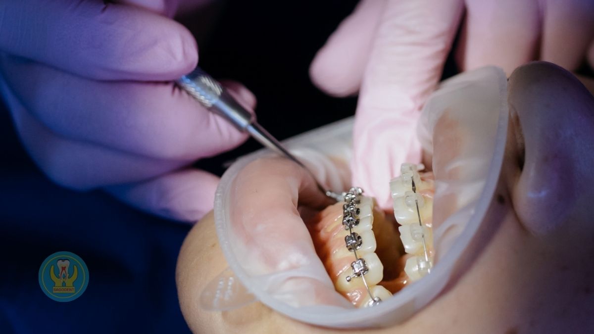 Nẹp cố định răng lung lay hỗ trợ hồi phục mô nha chu