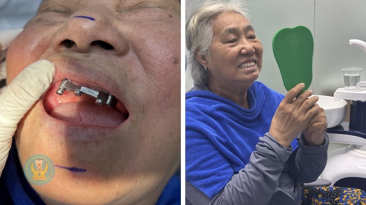 Cấy ghép implant tức thì trước và sau tại Nha Khoa Sài Gòn