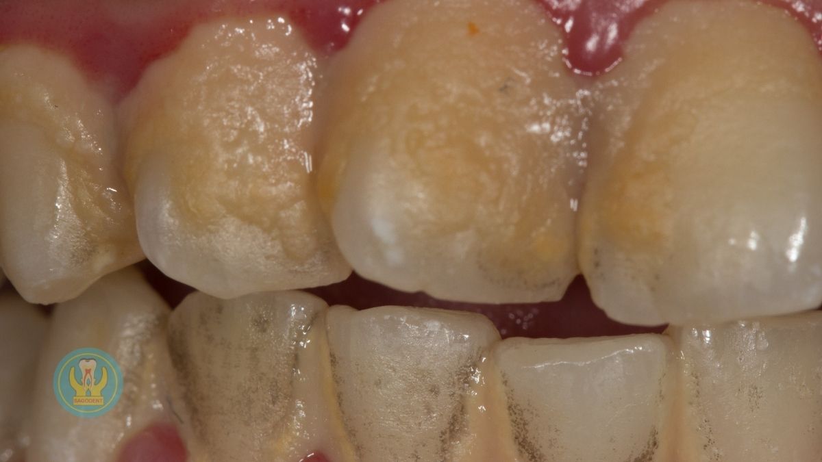 Biến chứng từ việc không xử lý mảng bám trên răng là gì