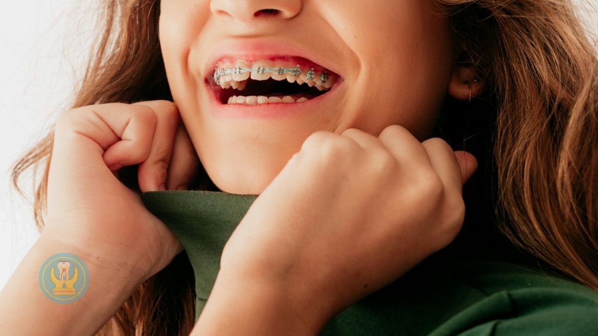 Tầm quan trọng của việc đeo hàm duy trì sau khi tháo niềng răng