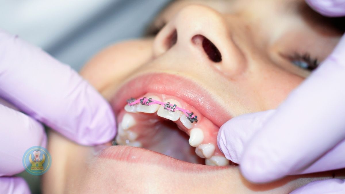 Các phương pháp chỉnh nha quyết định niềng răng mất bao lâu