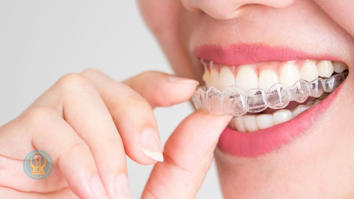 Kết quả thay đổi nụ cười sau khi niềng răng mất bao lâu