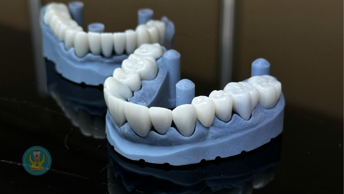 So sánh răng sứ Zirconia và răng sứ kim loại