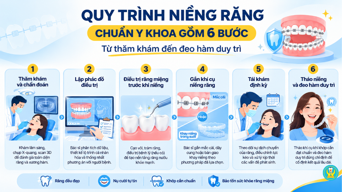 Quy trình niềng răng chuẩn y khoa gồm 6 bước từ thăm khám đến đeo hàm duy trì