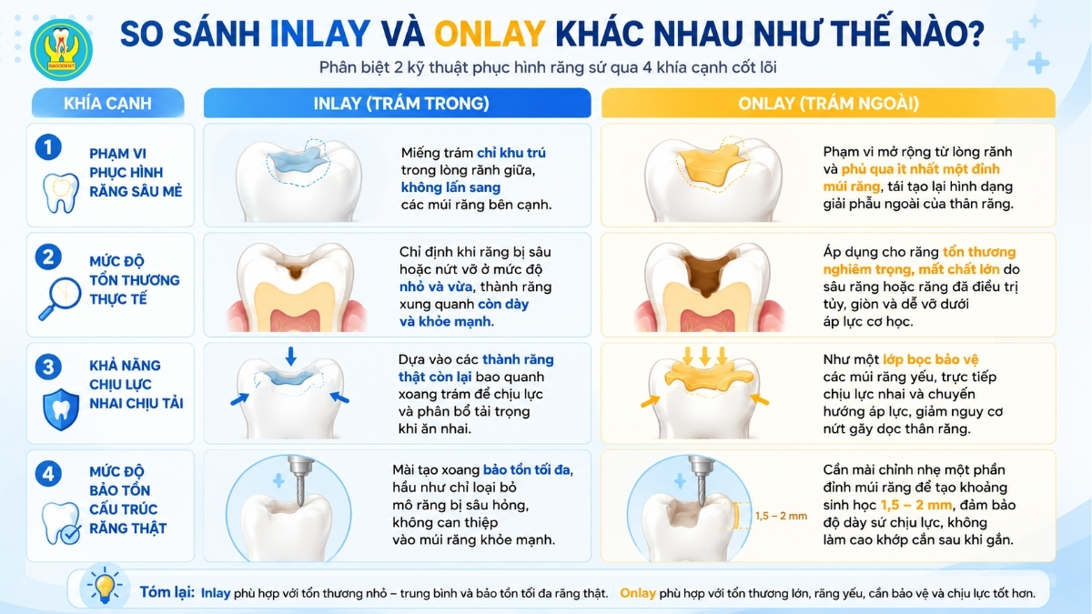 So sánh inlay và onlay khác nhau như thế nào
