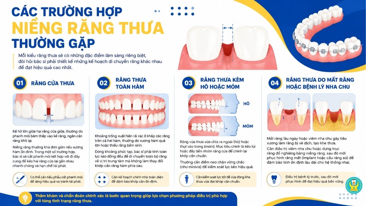 Các trường hợp niềng răng thưa thường gặp