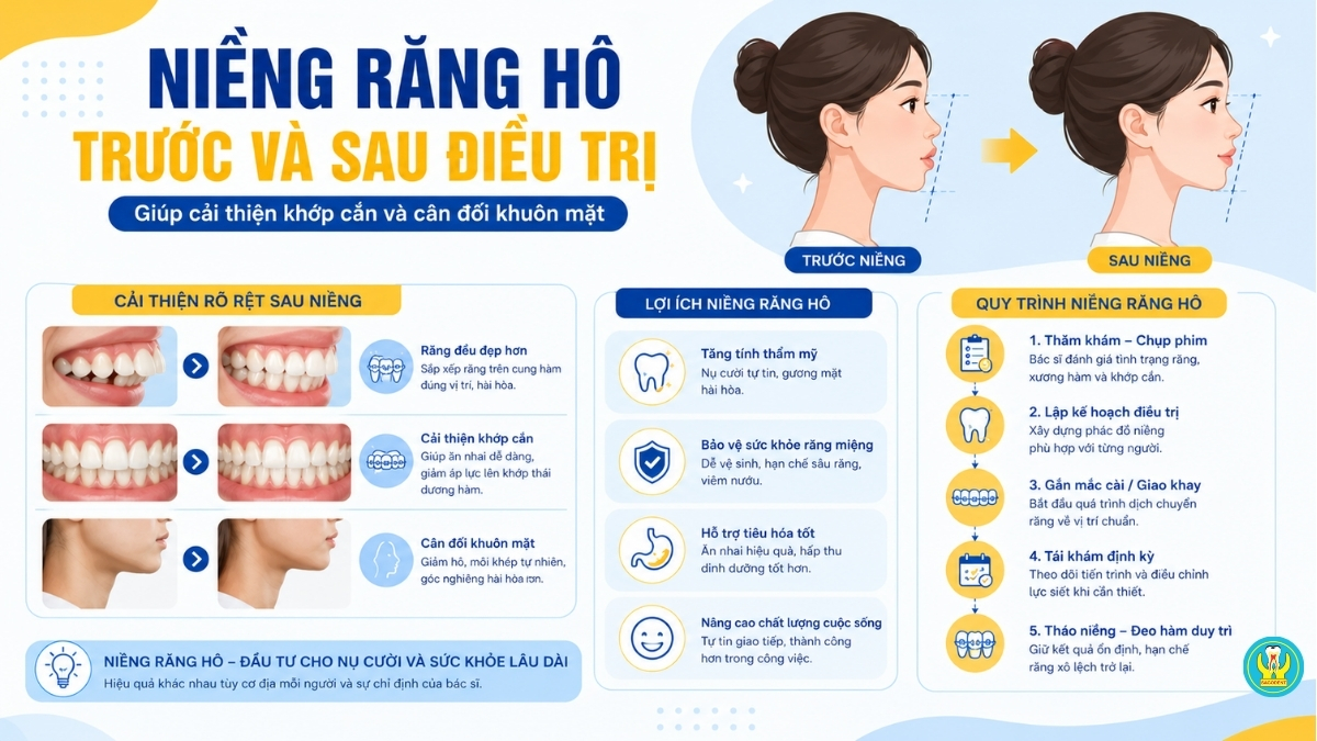 Niềng răng hô trước và sau điều trị giúp cải thiện khớp cắn và cân đối khuôn mặt
