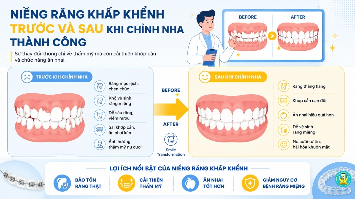 Niềng răng khấp khểnh trước và sau khi chỉnh nha thành công