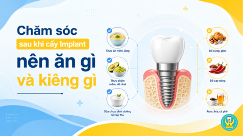 Chăm sóc sau khi cấy Implant nên ăn gì và kiêng gì