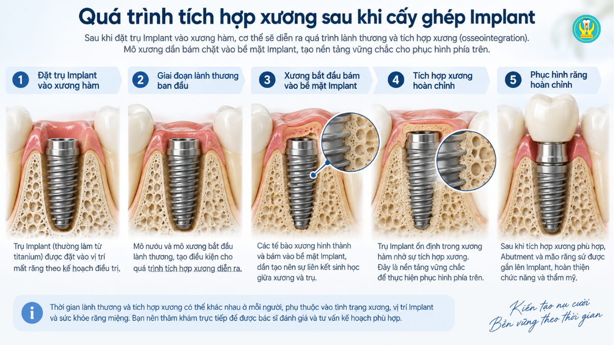Quá trình tích hợp xương sau khi cấy ghép Implant